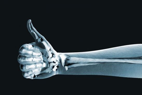 Rrezet X mund të ndihmojnë në diagnostikimin e dhimbjes në nyjet e gishtërinjve