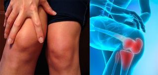 Siklet dhe ënjtje në zonën e gjurit janë simptomat e para të artrozës