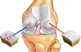 shkaqet e artrozës së kyçit të gjurit
